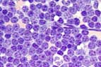 Leukemia