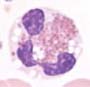 Eosinophilia