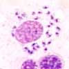 Leishmaniasis